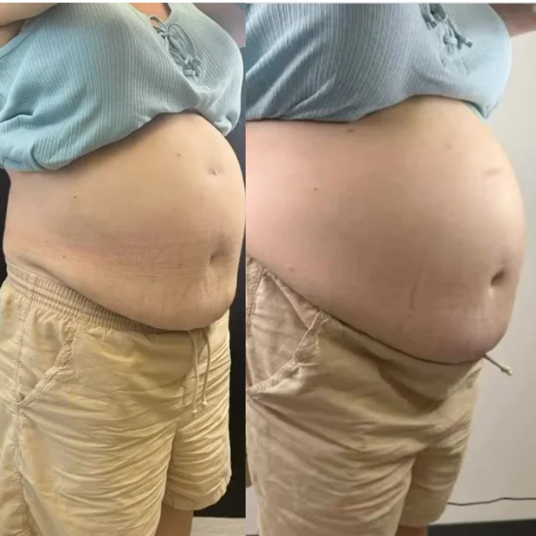 Semaglutide Weight Loss Support Cary, NC