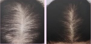 PRP Hair Restoration (Non-Surgical) Treatment Cary NC - Before and After