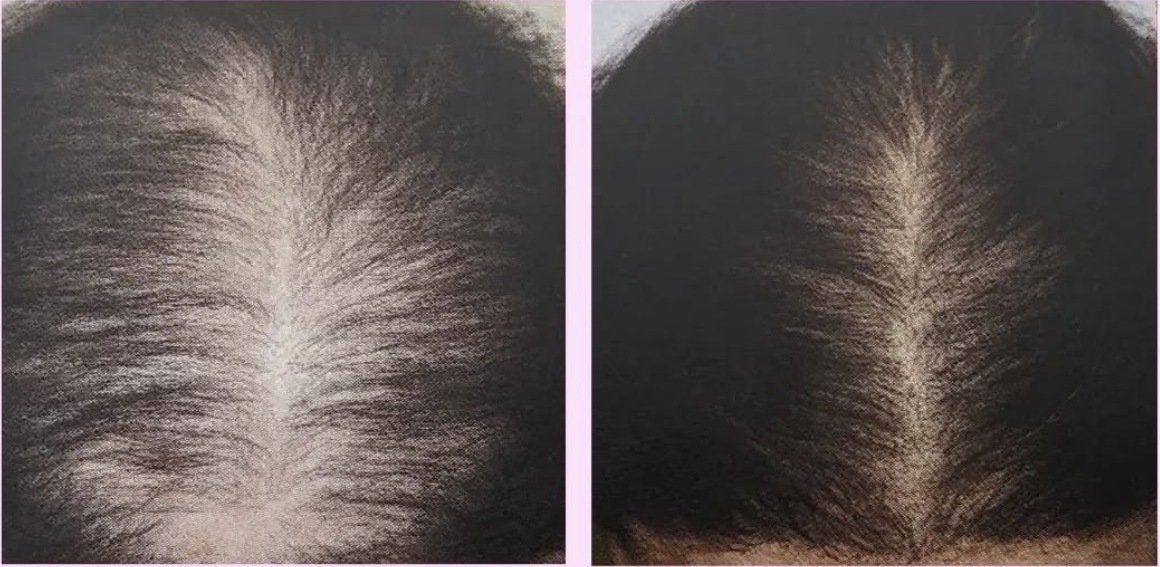 PRP Hair Restoration (Non-Surgical) Treatment Cary NC - Before and After