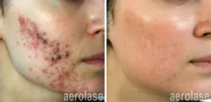 acne treatment cary nc