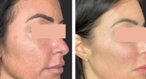 CO2 Laser Treatment Cary, NC