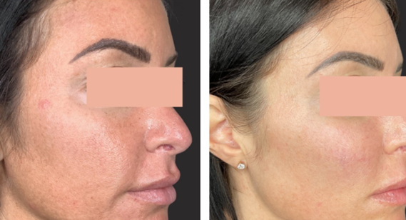 CO2 Laser Treatment Cary, NC